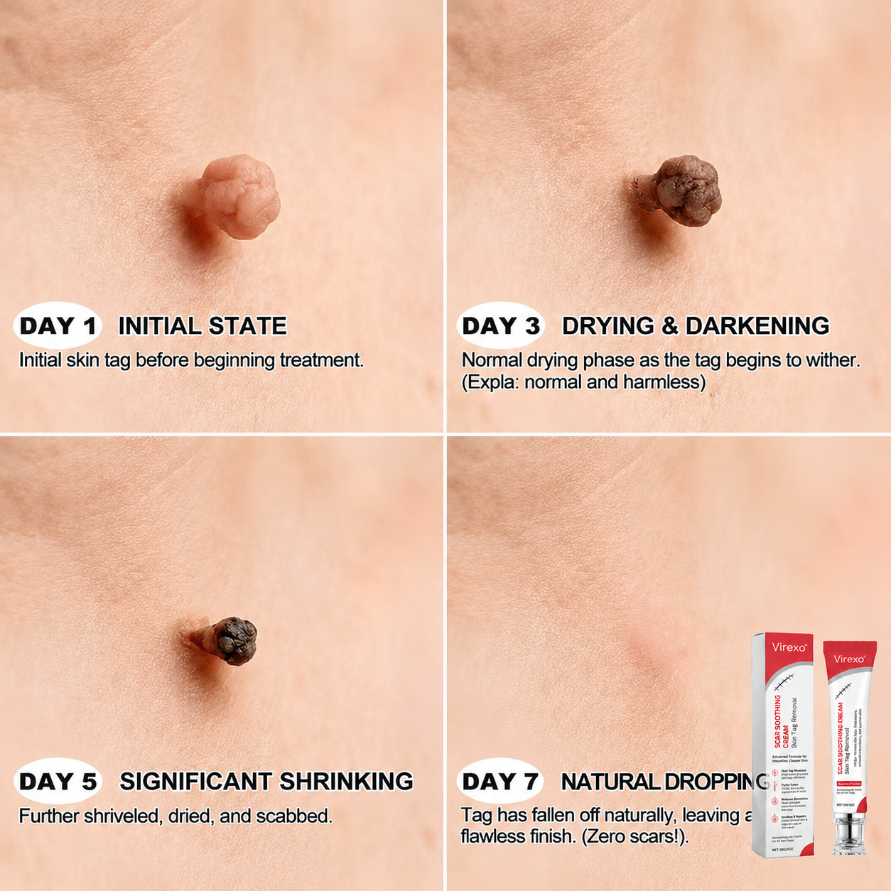 Virexo Scar Soothing Cream – Effective Skin Tag